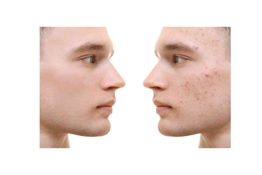 How to Get Rid of Acne Without Damaging Skin