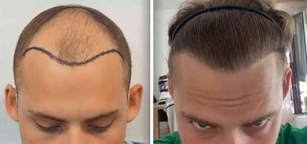 Hair Transplant Turkey